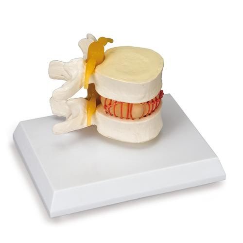 Simulator für Bandscheibenvorfall