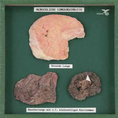 Objektkasten Raucherlunge, Lungenkarzinom und gesunde Lunge