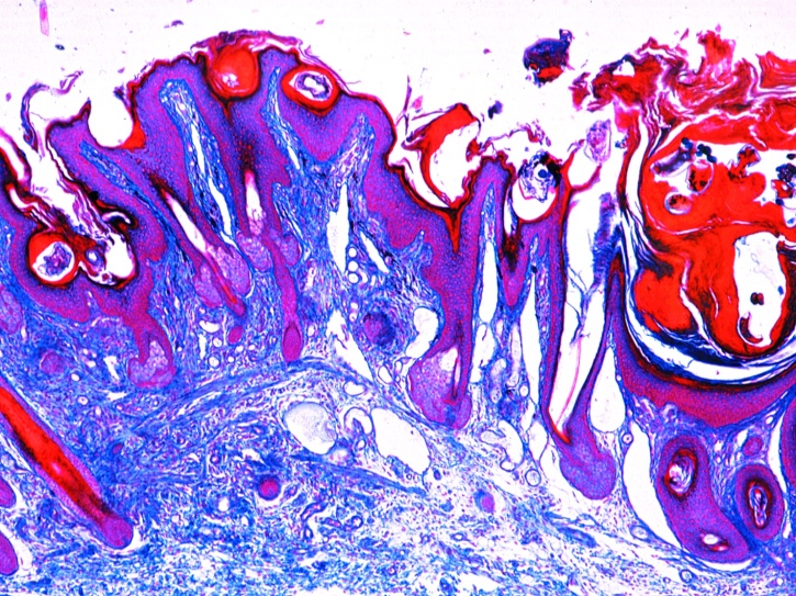 Mikropräparat - Sarcoptes sp., Krätzemilbe, Schnitt durch Haut mit Parasiten und Freßgängen