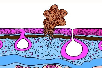 Mikropräparat - Schleimhautgeschwür eines Lurches als Folge von Wasserverschmutzung Mikropräparat - Schleimhautgeschwür eines Lurches als Folge von Wasserverschmutzung