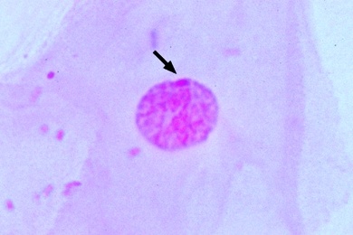 Mikropräparat - Barr Körperchen in den Zellen der Mundschleimhaut einer Frau