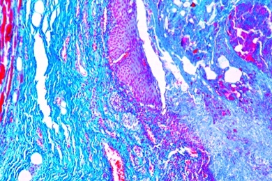 Mikropräparat - Nekrotisierende Oesophagitis, Krankhafte Veränderungen der Zellen und Gewebe