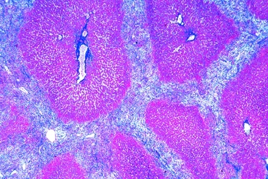Mikropräparat - Leberzirrhose, Krankhafte Veränderungen der Zellen und Gewebe