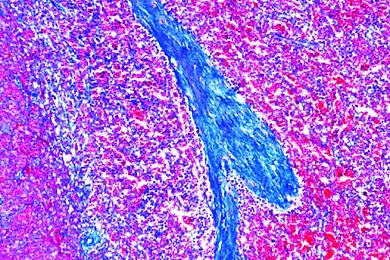 Mikropräparat - Milzinfarkt, Schädigungen der Kreislauforgane (Herz, Gefäße) und der blutbildenden Organe