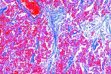 Mikropräparat - Chronische Pneumonie (Pneumonia chronica), Pathologische Veränderungen der Lunge und der Leber, Tuberkulose und Lungenentzündung