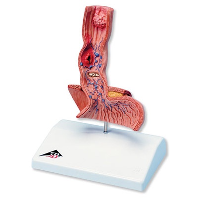 Erkrankungen der Speiseröhre