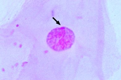 Mikropräparat - Barr Körperchen in den Zellen der Mundschleimhaut einer Frau