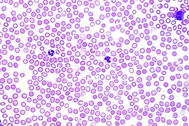 Mikropräparat Blut vom Menschen, Ausstrich, Wrights Färbung