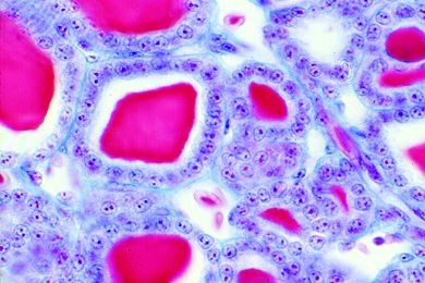 Mikropräparat - Schilddrüse des Menschen, hormonal bedingte Unterfunktion