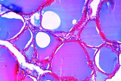 Mikropräparat - Schilddrüse des Menschen, hormonal bedingte Überfunktion