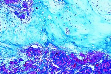 Mikropräparat - Fibroepithelialer Mischtumor der Parotis