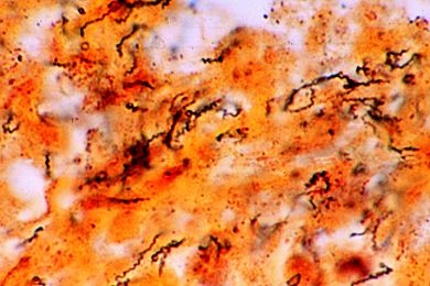 Mikropräparat - Konnatale Syphilis der Leber* Mikropräparat - Konnatale Syphilis der Leber*