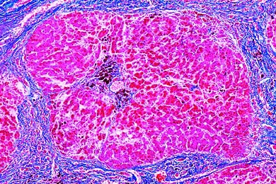 Mikropräparat - Pigmentzirrhose der Leber Mikropräparat - Pigmentzirrhose der Leber