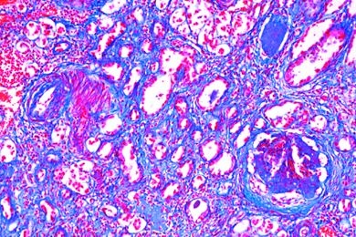 Mikropräparat - Schrumpfniere, Glomerularatrophie