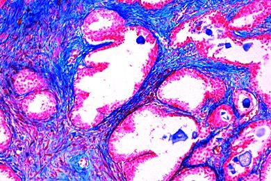 Mikropräparat - Adenomatöse Prostatahypertrophie Mikropräparat - Adenomatöse Prostatahypertrophie