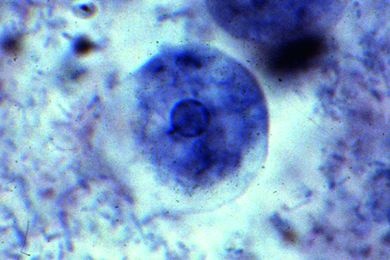 Mikropräparat - Entamoeba histolytica, Amöbenruhr, Ausstrich mit vegetativen Formen (Trophozoiten), Spezialfärbung *