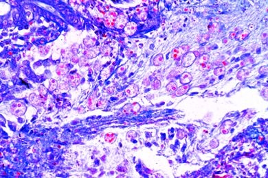 Mikropräparat - Entamoeba histolytica, Schnitt durch den erkrankten Dickdarm mit Parasiten in situ (Amöbenabszeß)