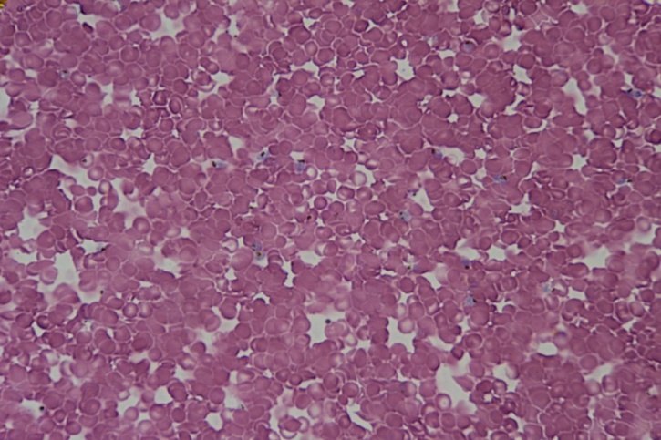 Mikropräparat - Plasmodium falciparum, Erreger der Malaria tropical