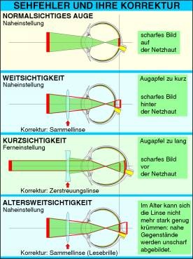 Transparentsatz Sehfehler und ihre Korrektur