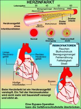 Digitale Folien auf CD, Herzinfarkt