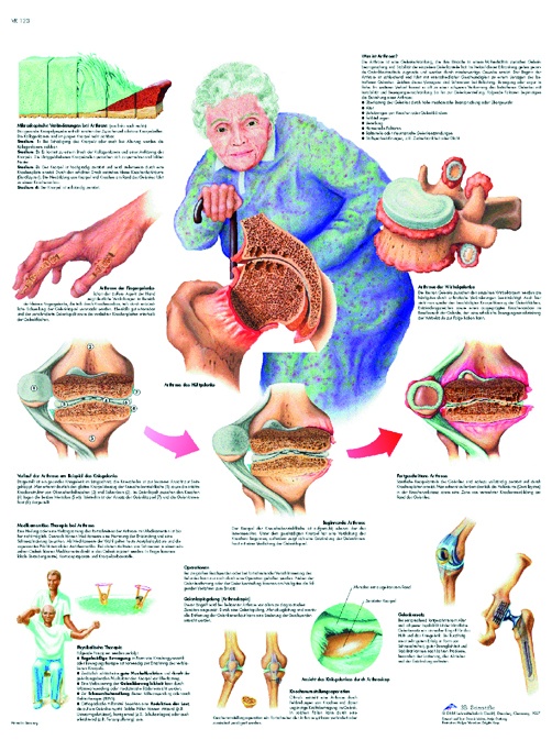 Anatomische Lehrtafel, Arthrose