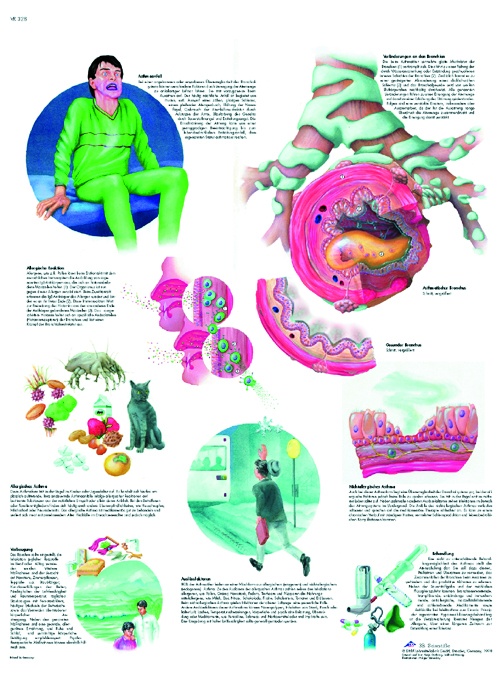 Anatomische Lehrtafel, Asthma