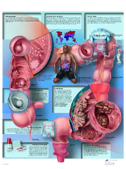 Anatomische Lehrtafel, Dickdarmkrebs