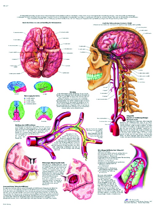 Anatomische Lehrtafel, Schlaganfall
