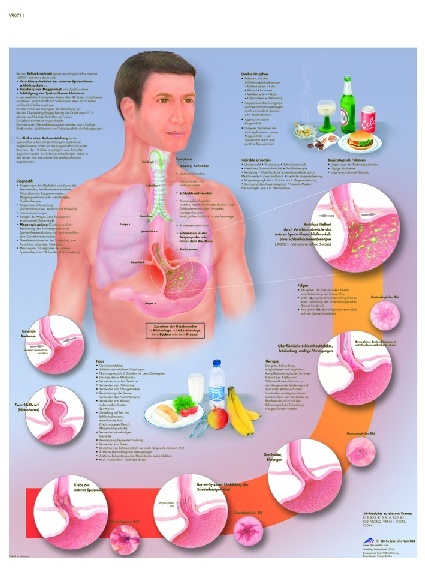 Anatomische Lehrtafel, Reflux-Krankheit
