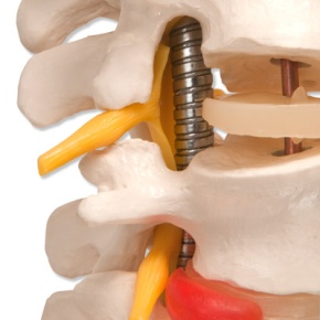 Flexible Wirbelsäule für starke Beanspruchung, Super robust